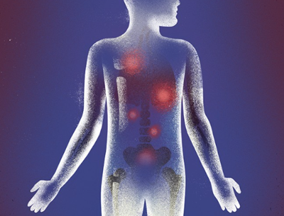 New Hope for Metastatic Prostate Cancer: From Lu-177 & Ac-225 Targeted Therapies to Personized DC Vaccine