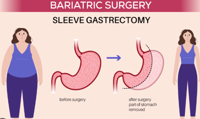 Exploring the Gastric Sleeve: A Proven Weight Loss Solution