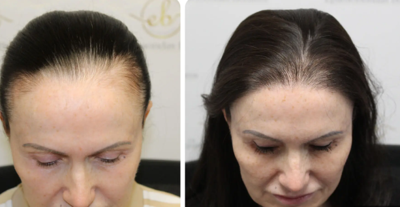 Top Factors to Consider Before Getting a Hair Transplant