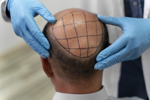 Everything You Need to Know When it Comes to Hair Transplants