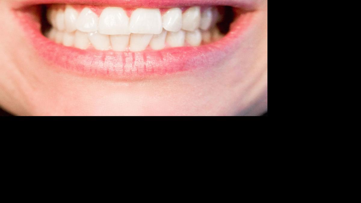 How To Get Your Smile Back: The Pros And Cons Of Dental Implants