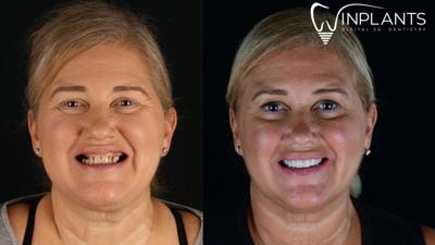 All-on-4 Dental Implants: A Permanent Solution For Missing Teeth
