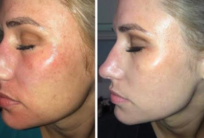 How Clear and Brilliant Laser Helps Rejuvenate Skin