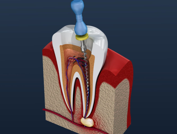How Root Canal Treatment Can Relieve Pain and Protect Your Smile