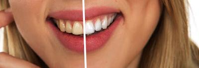 6 Reasons Teeth Whitening Will Never Go Out of Trend