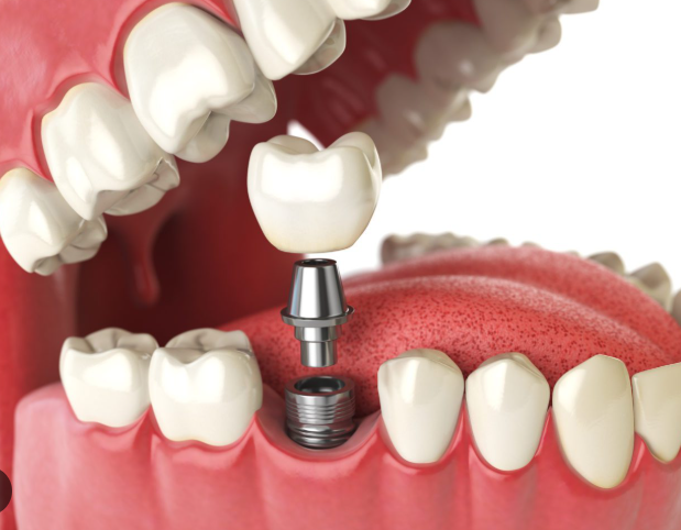 How Much Do Dental Implants Cost?