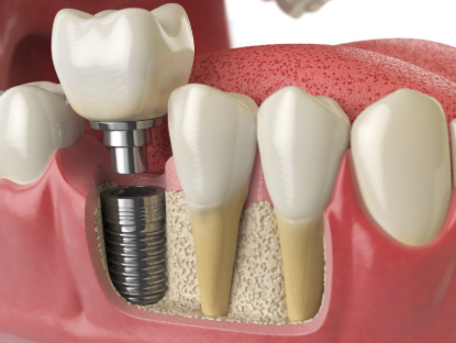 How Much Do Dental Implants Cost?