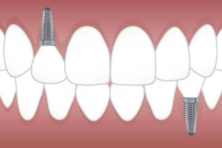 How Dental Implants Can Restore Your Smile With Confidence