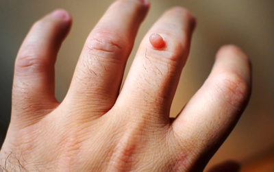 How to Naturally Remedy Warts on Your Fingers and Hands