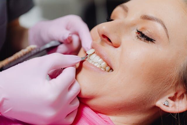 5 Facts Slidell Residents Should Know About Veneers