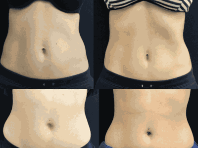 How Long Do EMS Body Sculpting Results Last?