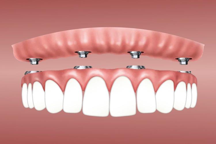 How Dental Implants Can Restore Your Smile With Confidence