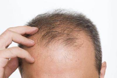 The Three Types of Alopecia Hair Transplants Can Reverse