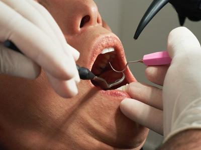 The Best And Worst Types Of Dental Fillings
