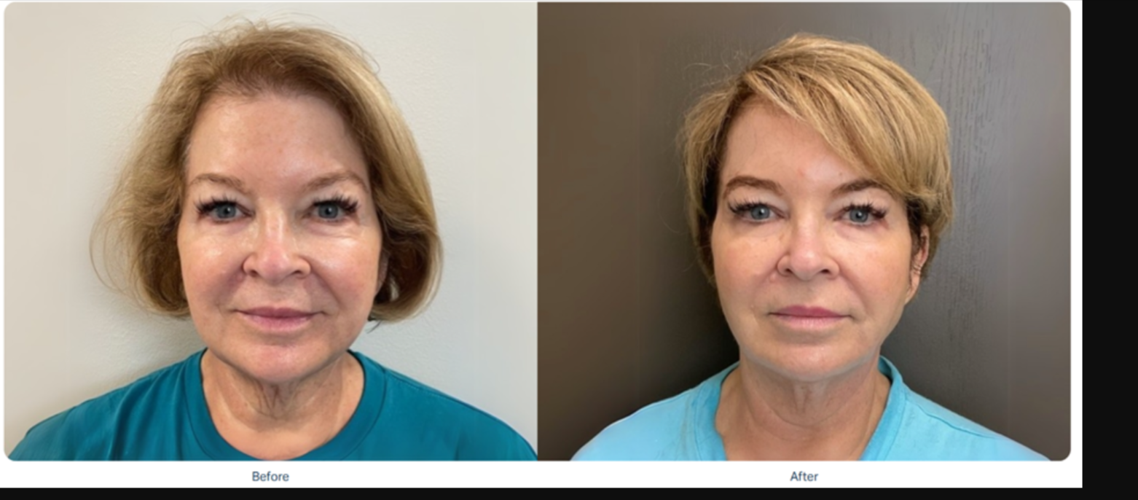 Ozempic Face Treatment: Understanding and Addressing Facial Volume Loss from GLP-1 Medications