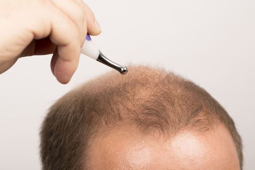 Everything You Need To Know About Hair Restoration For Men