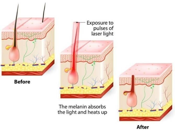 How Permanent Hair Reduction Supports Sensitive Skin Care