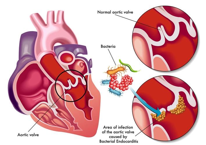 The Heart of the Matter: Endocarditis vs. Myocarditis Explained