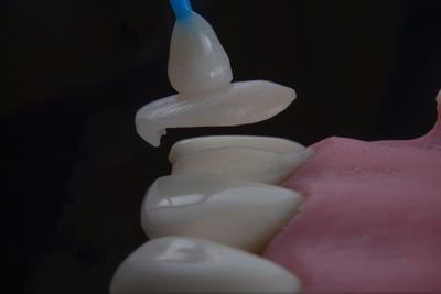 Transform Your Smile with Dental Veneers in Dubai