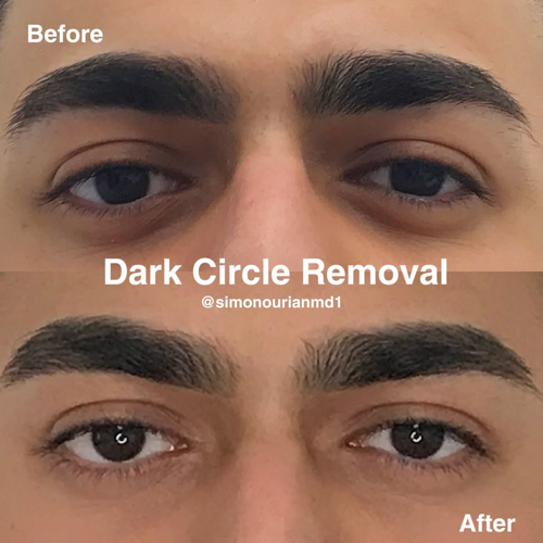 Epione Beverly Hills Redefines Beauty with Long Lasting Dark Circle Treatment