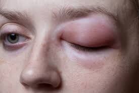 Symptoms and Attacks of Hereditary Angioedema