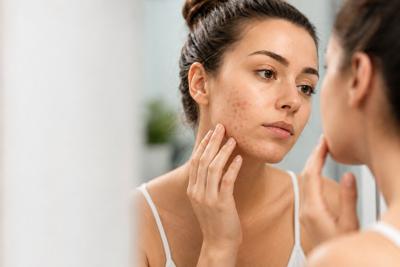 How To Adult Acne Problem and Solutions
