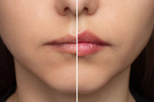 Pain-Free Lip Injections: What You Can Do to Minimize Discomfort