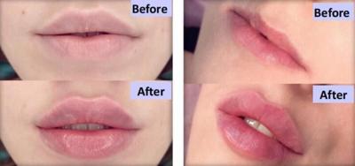 Hyaluronic Acid Lip Filler Marin County vs Traditional Lip Fillers: Which Lasts Longer?