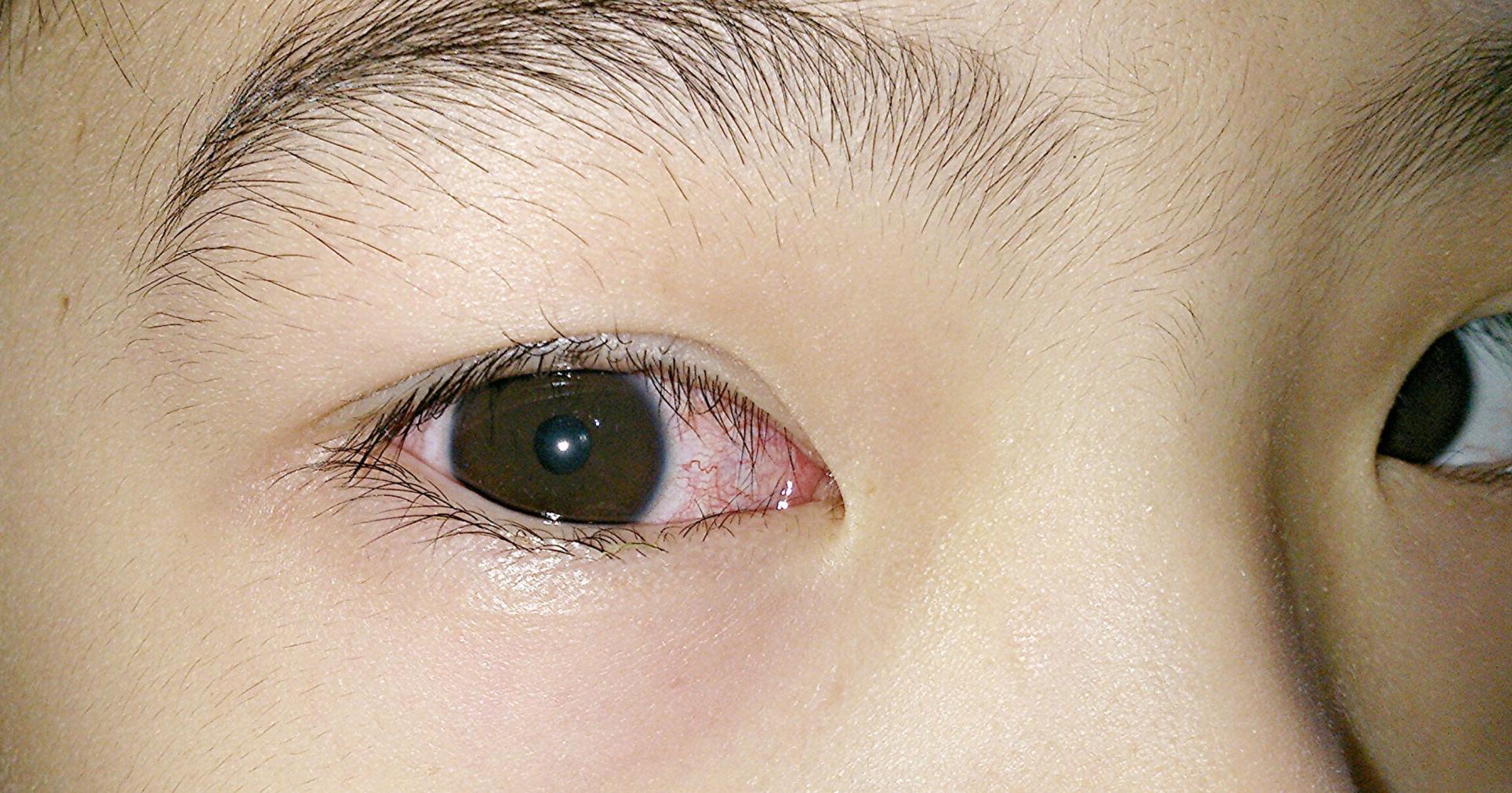 Does COVID cause pink eye? Is there a new subvariant? Here's what experts say. | Health - Vimarsana News