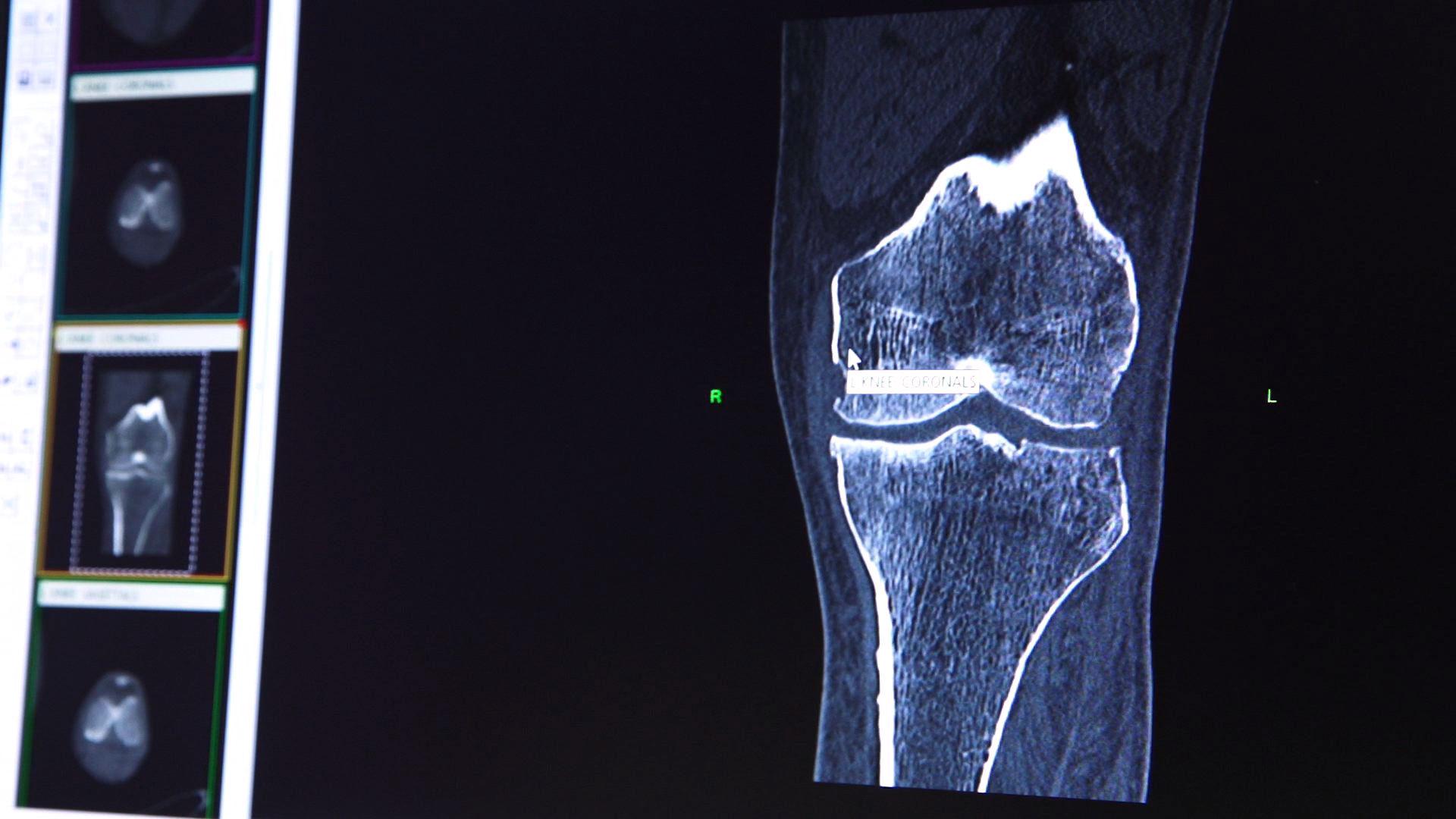 Colorado Springs Surgeon Among First To Offer 3 D Printed Knee