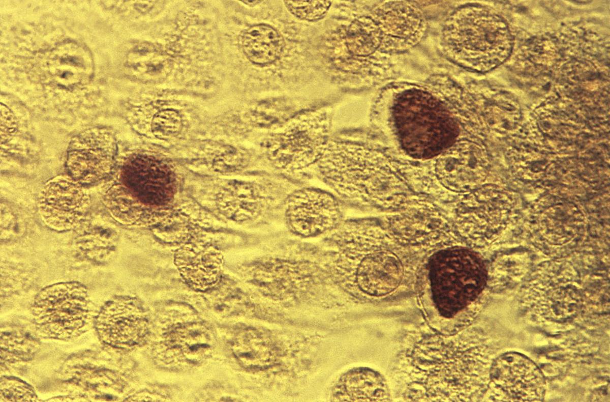 Alarming Rise In Sexually Transmitted Diseases Reported In El Paso County And Statewide Health Gazette Com