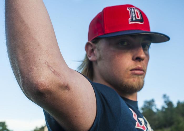 For players, Tommy John scars tell a story, Sports