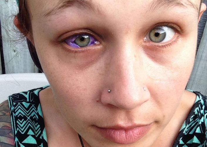 Model goes blind after tattooing eyeball, warns others of dangers
