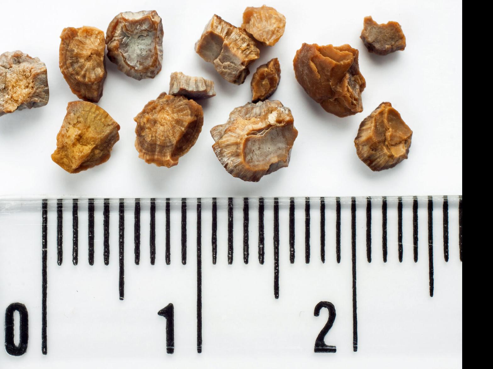 can dogs live with kidney stones
