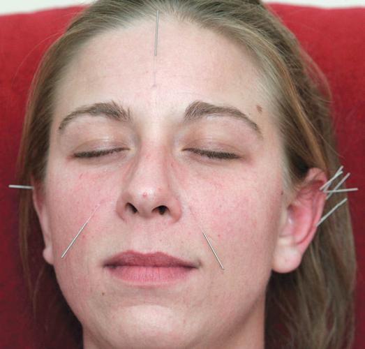 Community acupuncture makes a point in Janesville Archives