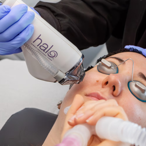 Laser Center of Marin Brings HALO Ablative-Non-Ablative Combo
