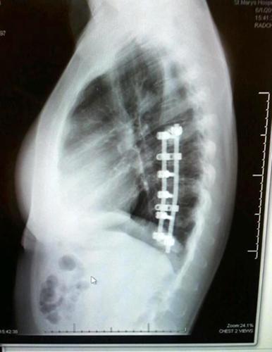 Woman injured by multiple DUI driver backs legislation | Western ...