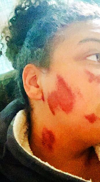 Wisconsin Woman Wants Burn Attackers To Know They Hurt Her News