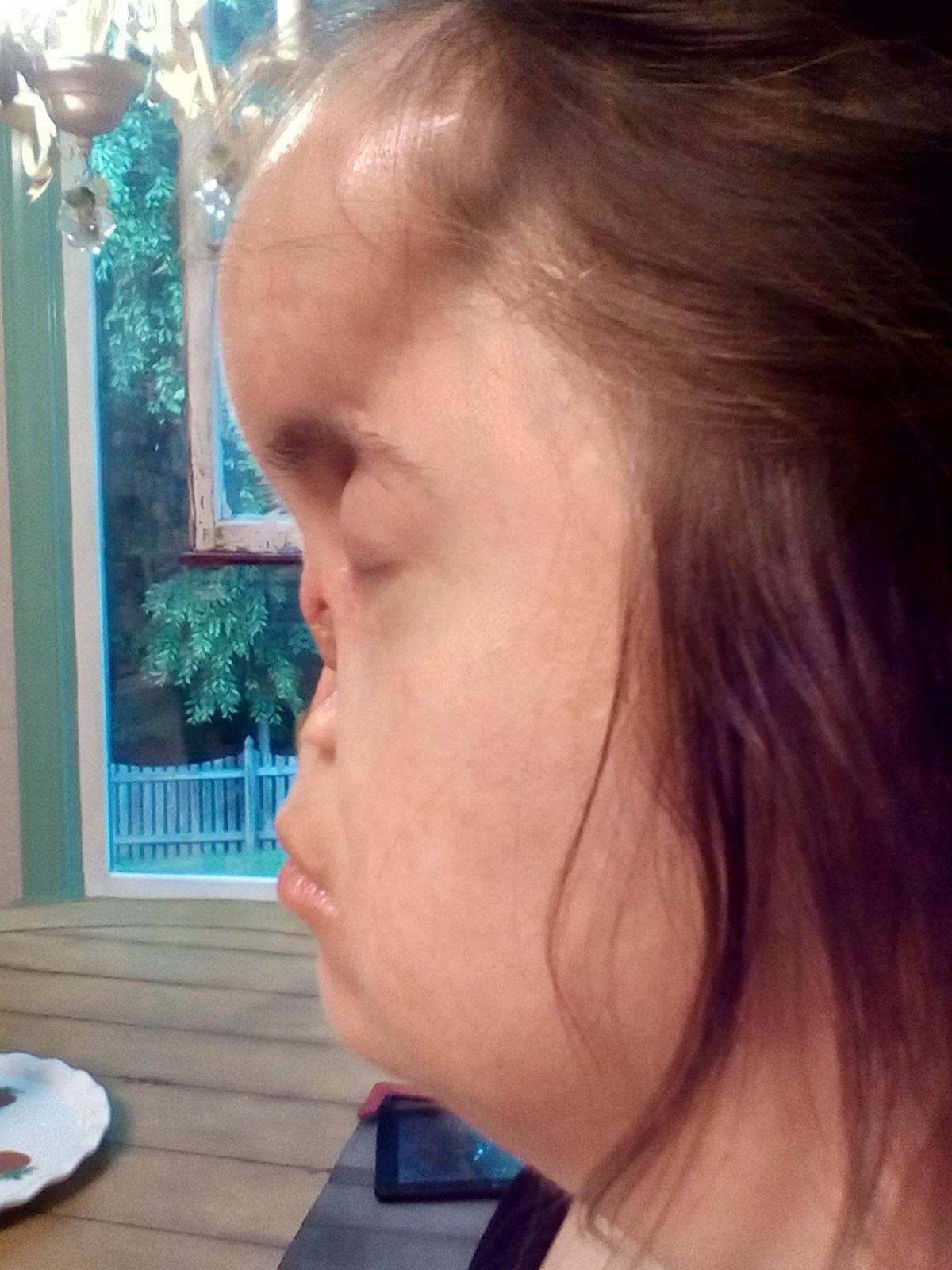 Dog Bite To Face Doesn T Dampen Greensboro Special Olympian S Spirit Local News Greensboro Com