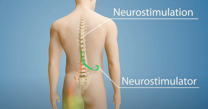 GRMC launches first-in-Guam pain relief Inceptiv spinal cord stimulator
