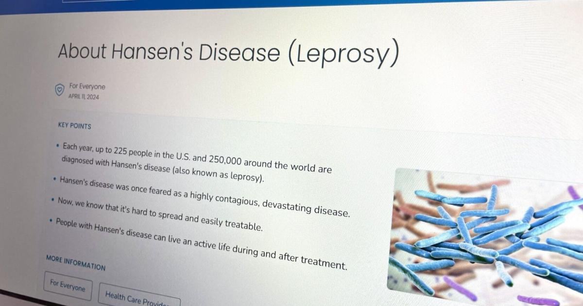 Public Health: New leprosy case on Guam locally transmitted