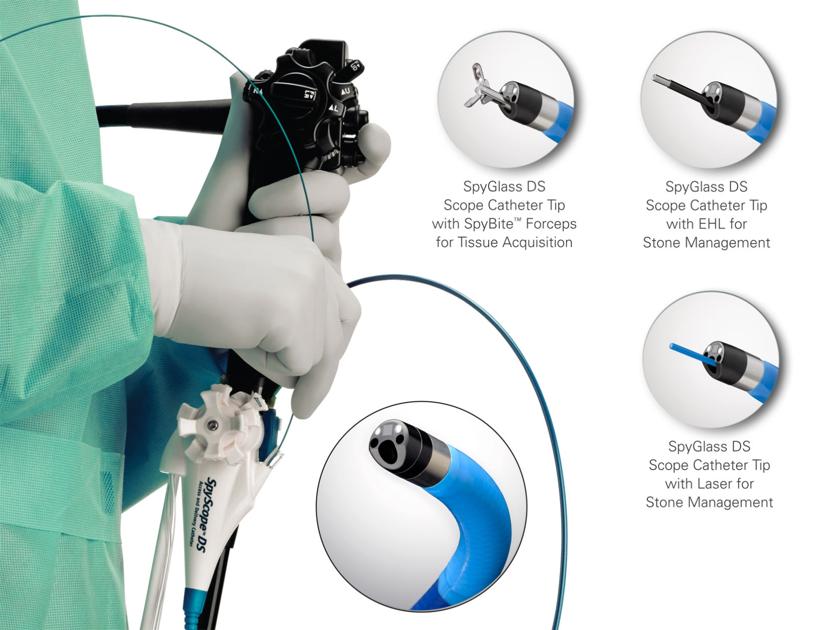 SpyGlass technology helps doctors quickly determine medical condition
