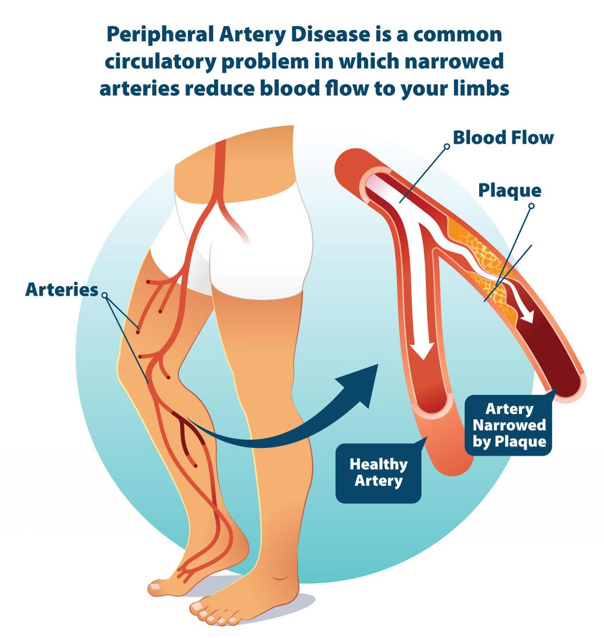 St Mary S Regional Heart Institute To Begin Supervised Exercise Program For Treatment Of Peripheral Artery Disease Healthsource Herald Dispatch Com