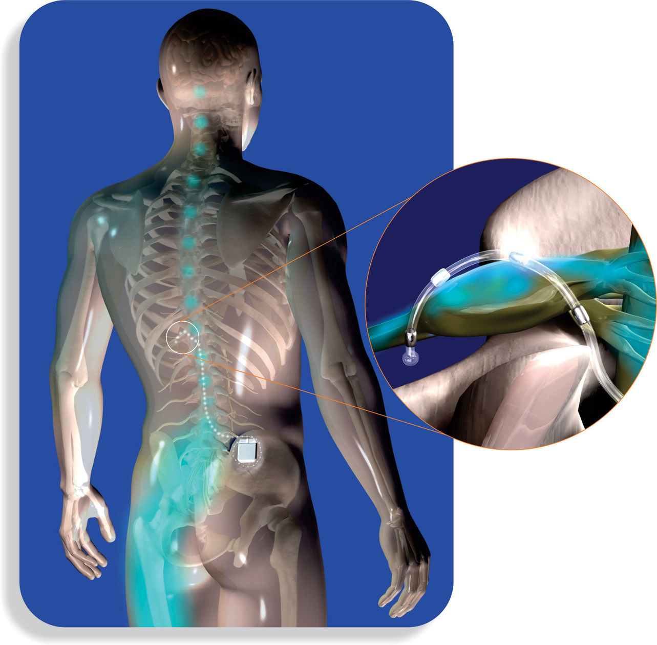 dorsal column stimulator treatment in philadelphia pa