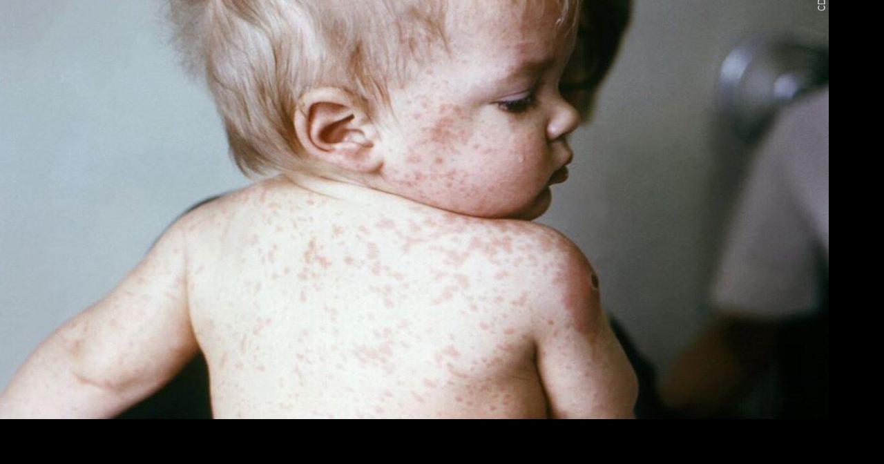 Health officials report measles outbreak in two Kentucky counties