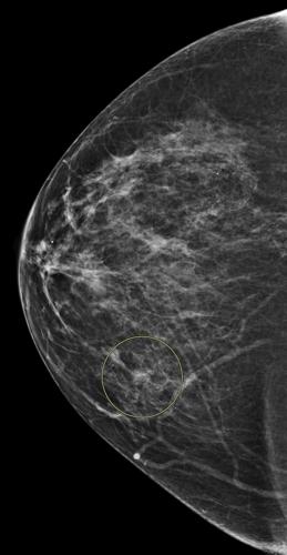 Understanding the vital role of diagnostic breast imaging | Health ...
