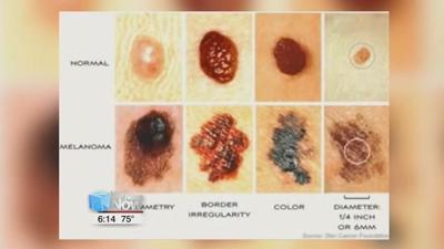 Mole patrol at St. Rita's