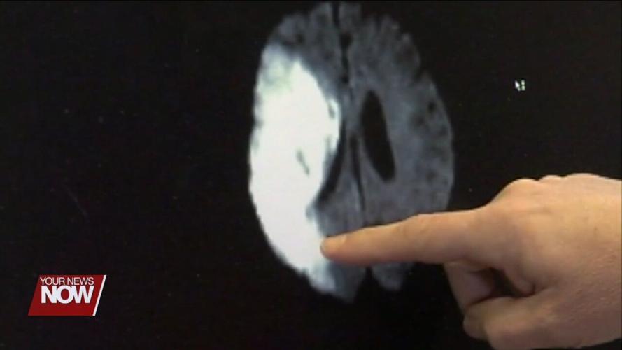 Know the warning signs of a stroke
