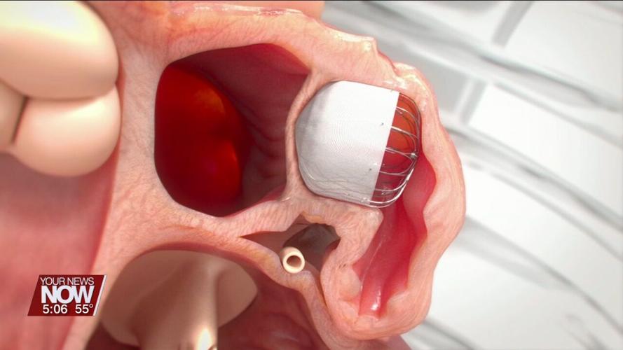New device helps prevent strokes in people who have AFib