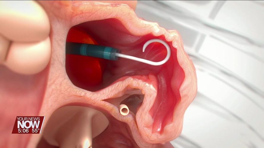 New device helps prevent strokes in people who have AFib